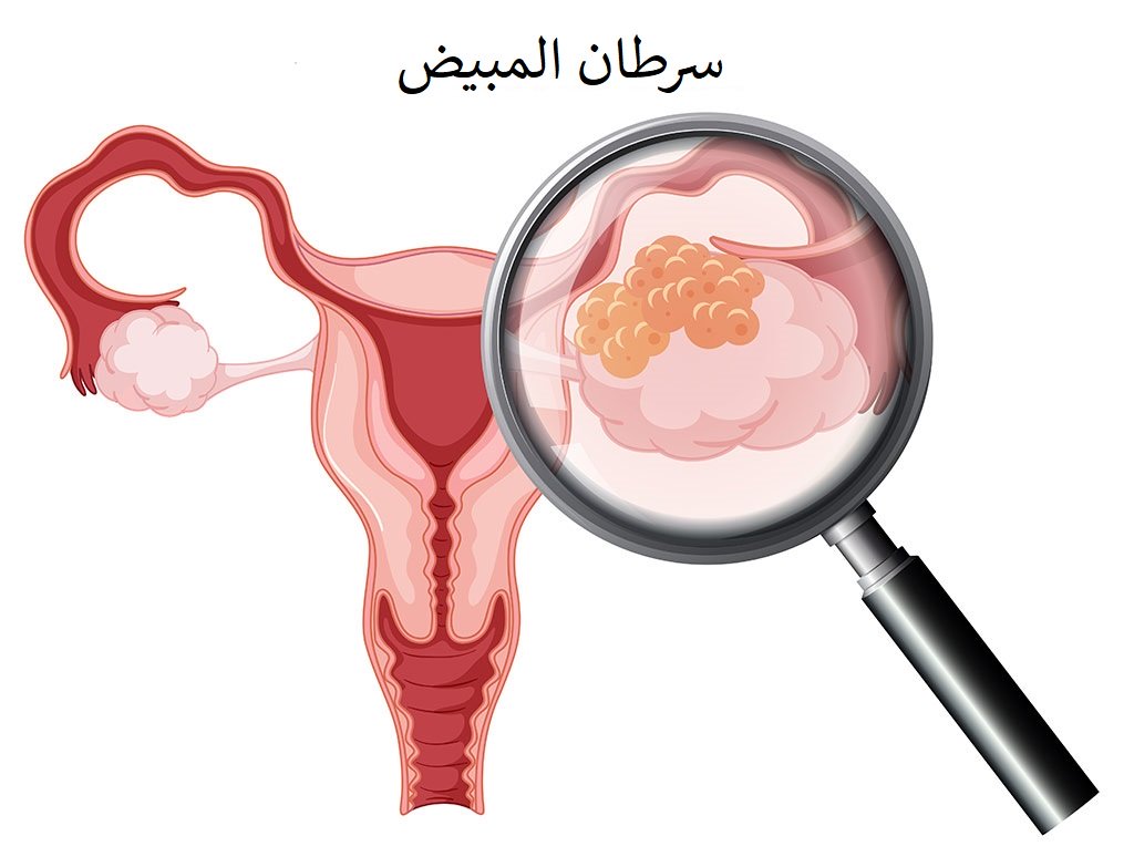 مرض النساء الاول - سرطان المبيض اعراضه 8061 2