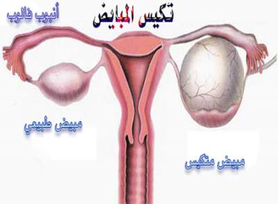 مشكلات وحلول , تكيسات المبيض واسبابها