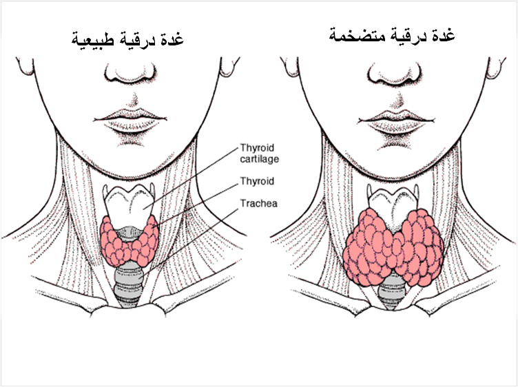 علاج التهاب الغدة الدرقية بالاعشاب - تخلصوا من الغدة الدرقية نهائيا 👇 8471