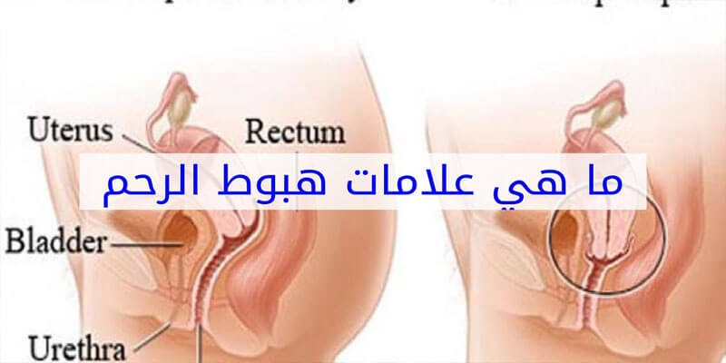 علاج هبوط الرحم , علاج بسيط و سهل